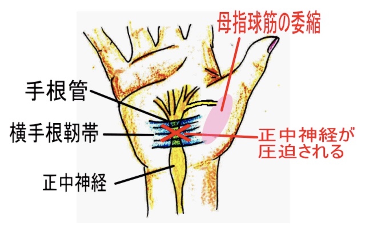 手根管症候群の手術にはどのような内容が含まれますか?