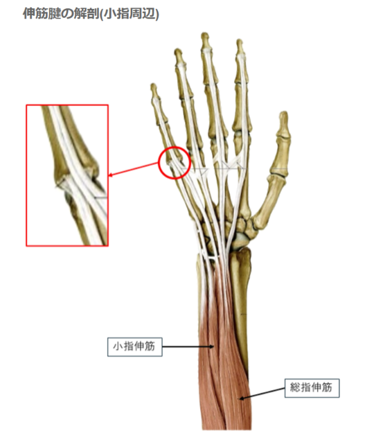 非外傷性伸筋腱脱臼（ばね指と間違われやすい疾患） - 大阪 ばね指の